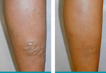 Before and After large bulgin varicose veins