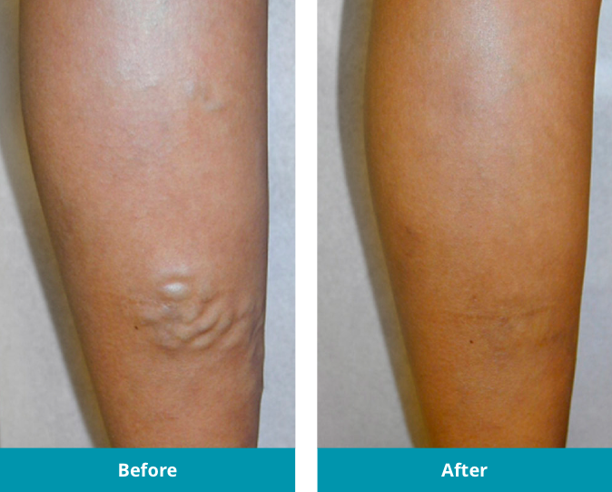 Before and After large bulgin varicose veins