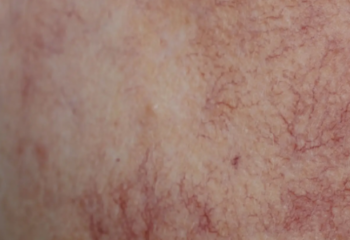 varicose veins