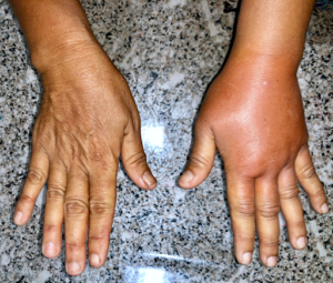lymph hand