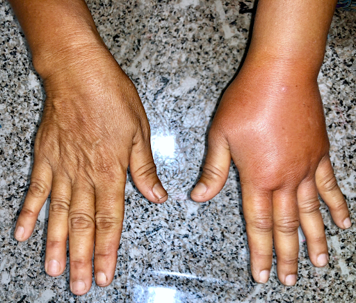lymph hand